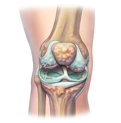 Zerstörung von Gelenken mit der Entwicklung von Osteochondrose