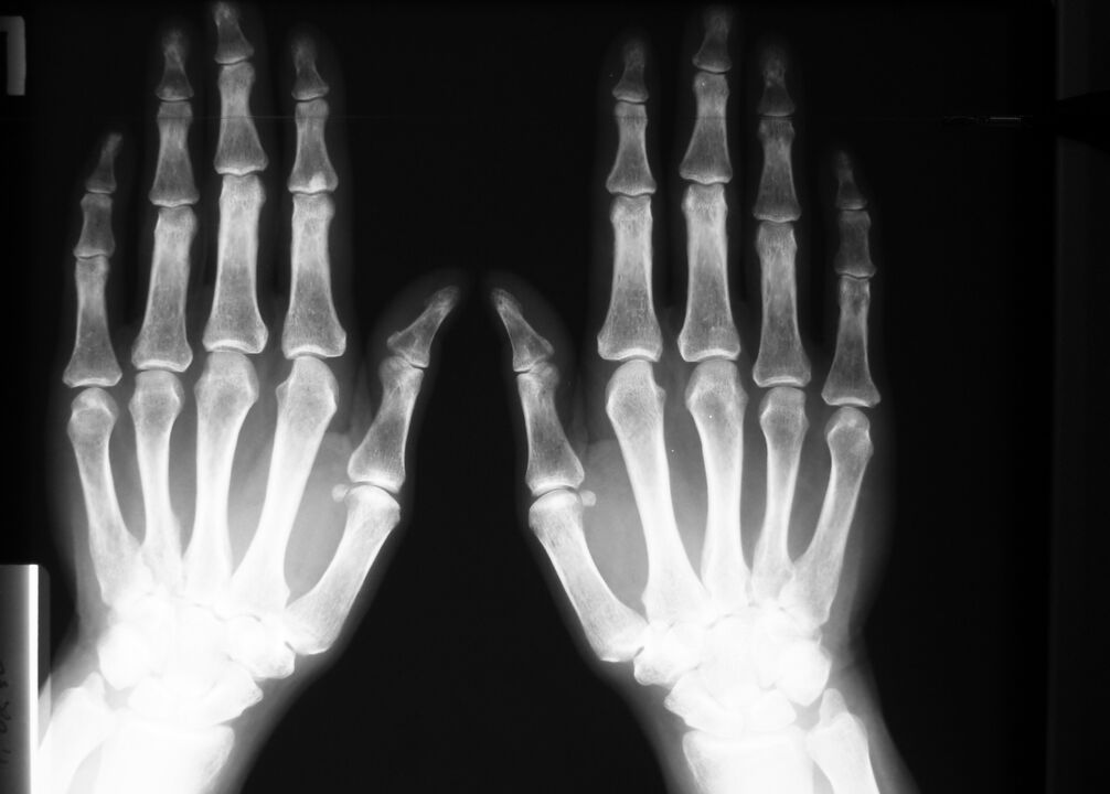 Röntgen zur Diagnose von Schmerzen in den Fingergelenken.